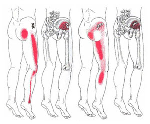 Trigger Points